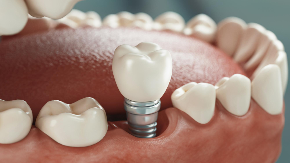 Dental Implants  Holliston, MA